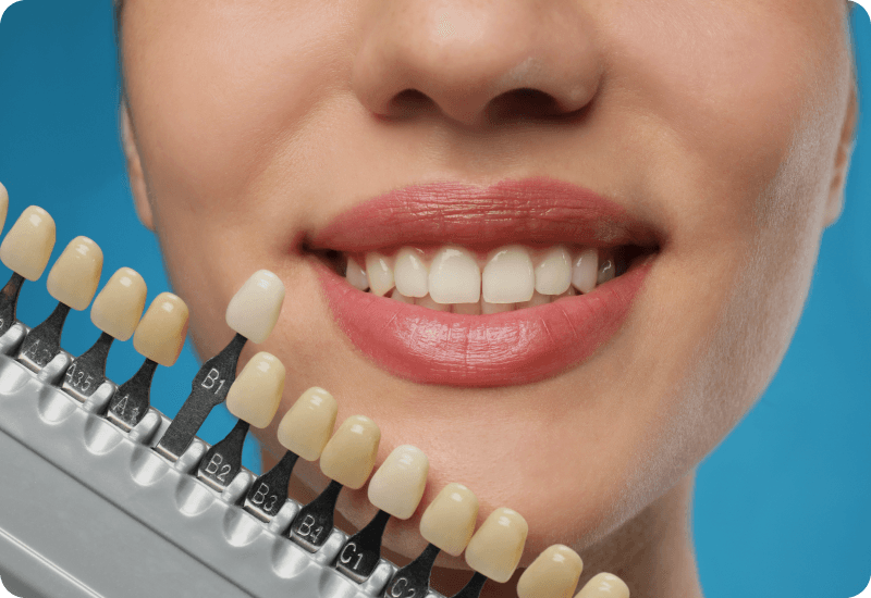 Dental shade matching for dental hygiene